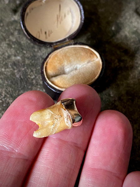 A Rather Macabre Tooth With A Heavy Solid 22ct Gold Crown In An Old Ring Box